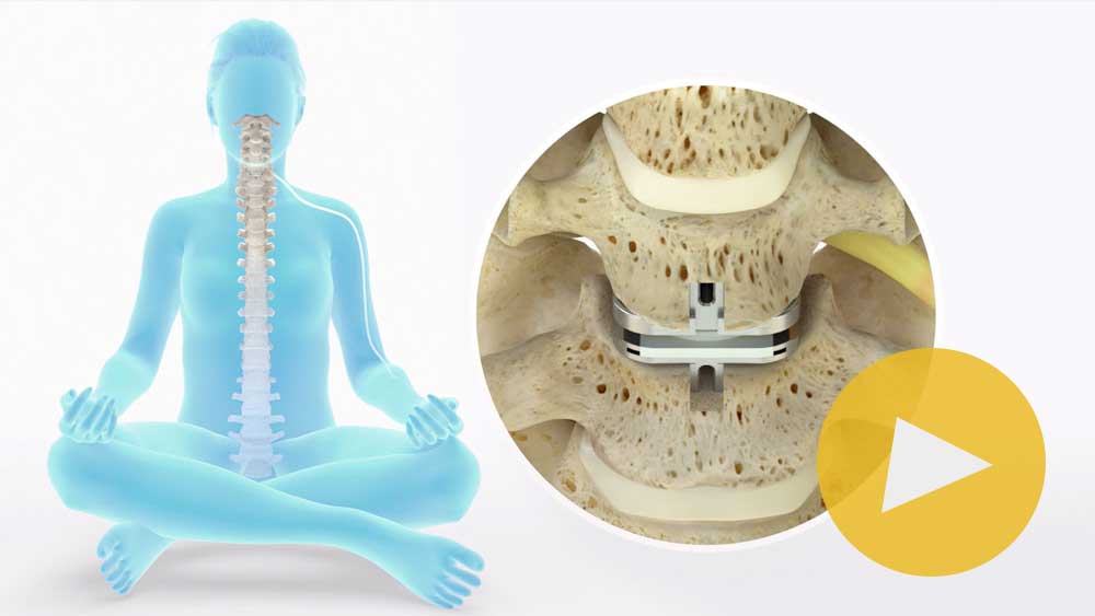 Learn More About Cervical Total Disc Replacement with prodisc