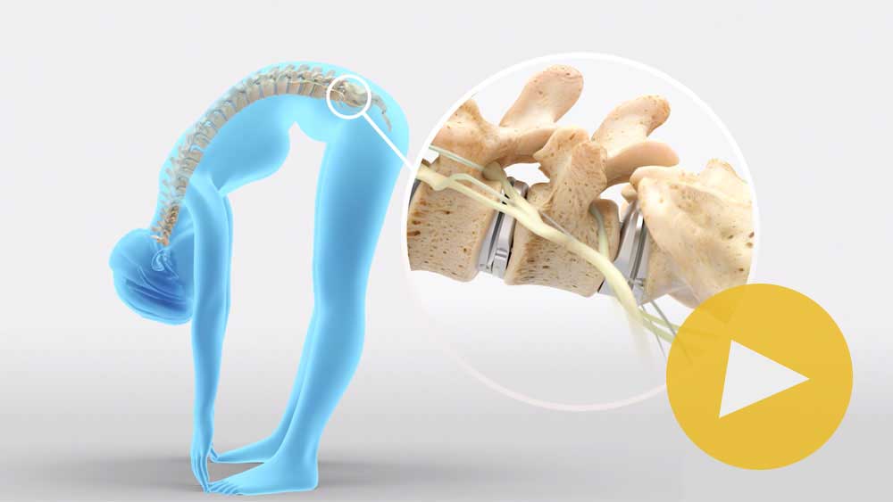 Learn More About Lumbar Total Disc Replacement with prodisc