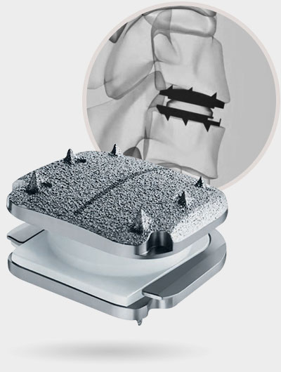 Centinel Spine For Stalif Stalif C Stalif C Ti