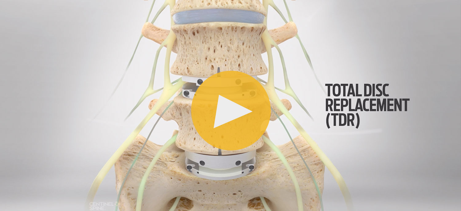 Total Disc Replacement as an Alternative to Fusion