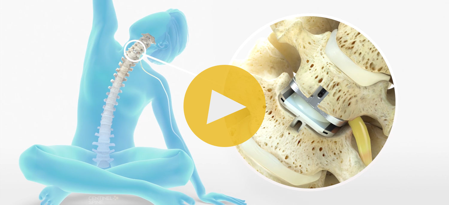 Total Disc Replacement as an Alternative to Fusion